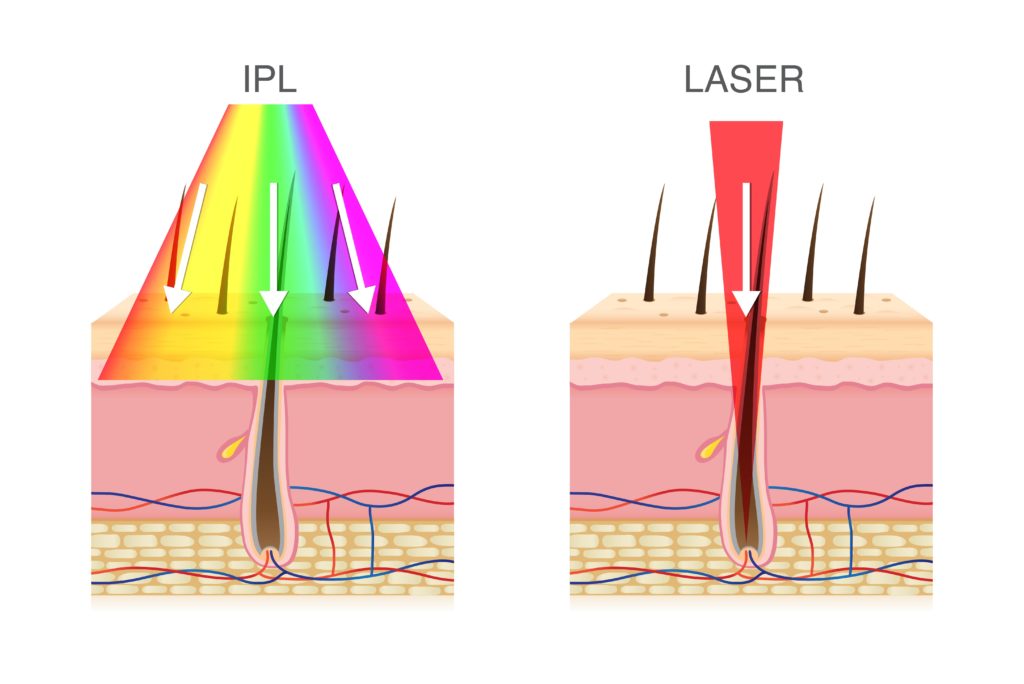 IPL vs. laser